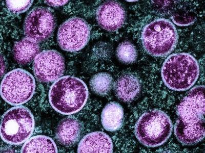 Monkeypox viruses under microscope