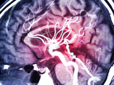 MRI of brain blood vessels