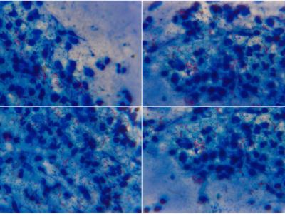 Tuberculosis bacteria