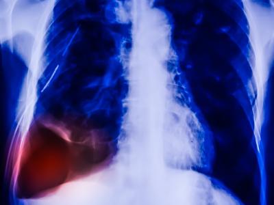 Pneumothorax x-ray
