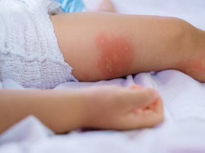 Rash on baby's leg