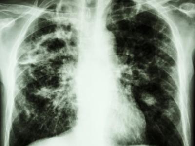 TB chest x-ray