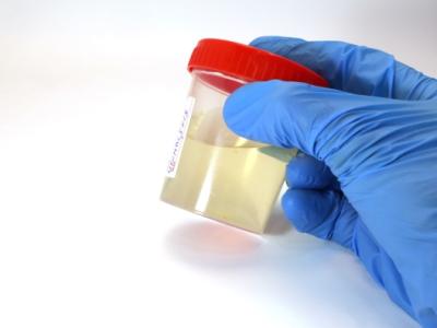 Urinalysis container