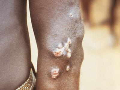 Yaws lesions on elbow