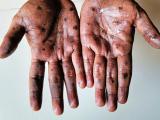 mpox lesions
