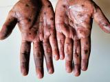 mpox lesions