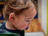 Toddler with measles