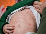 measles boy 