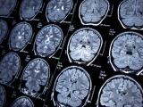 brain MRI