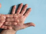 mpox hands