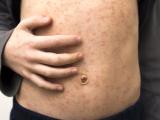 measles abdomen