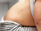 measles child back