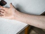 measles rash on arm