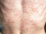 measles torso