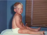 measles child 