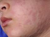 child with measles