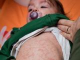Baby with measles