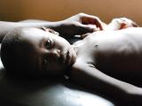 Rehydration therapy for diarrhea