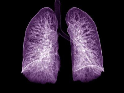 Purple lungs on x-ray