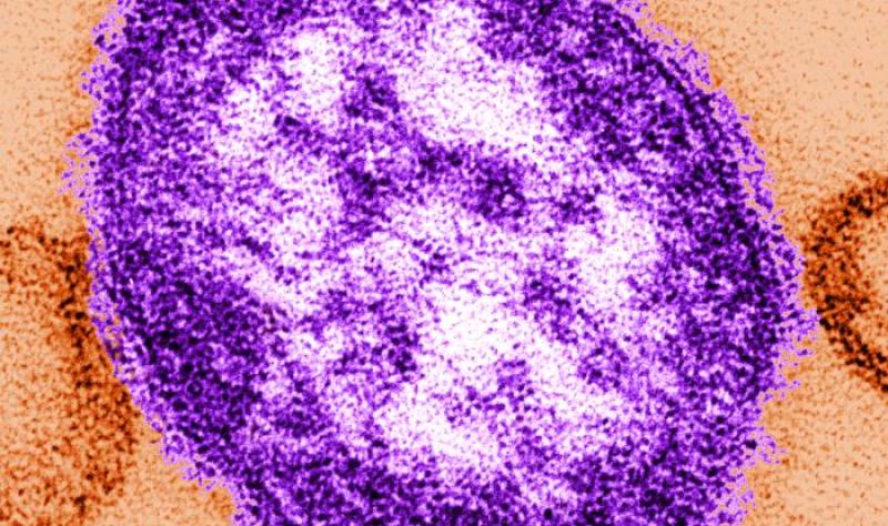 measles image 