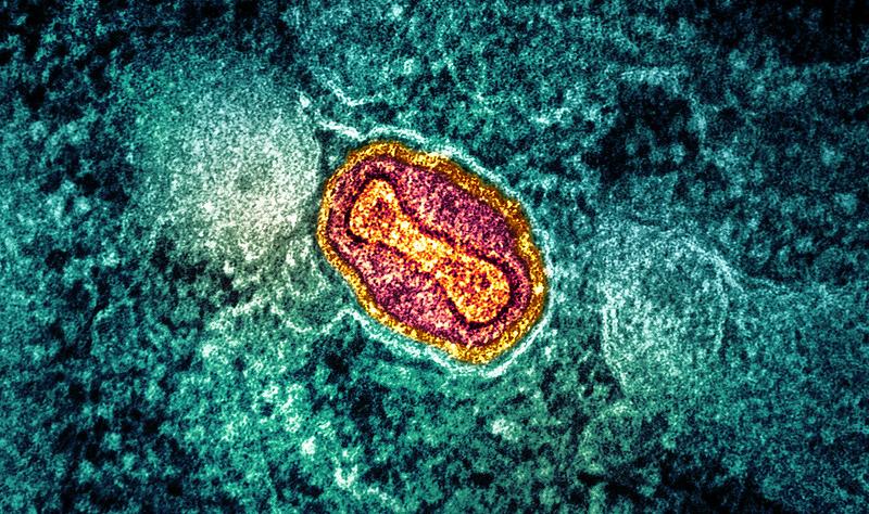 Clade 1b mpox outbreak in DR Congo linked to sex workers; New York reports first case Clade 1b mpox outbreak in DR Congo linked to sex workers; New York reports first case