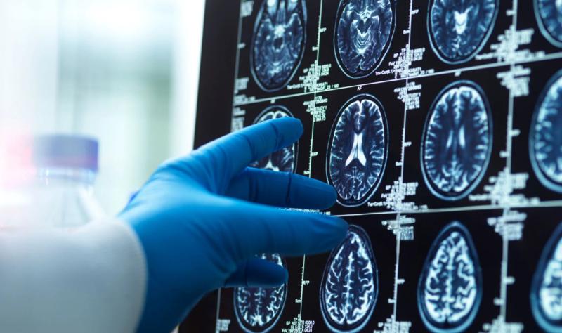 Brains aged faster during the COVID pandemic—even among the uninfected, data suggest Brains aged faster during the COVID pandemic—even among the uninfected, data suggest
