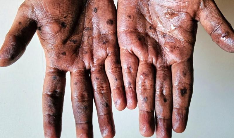 mpox lesions