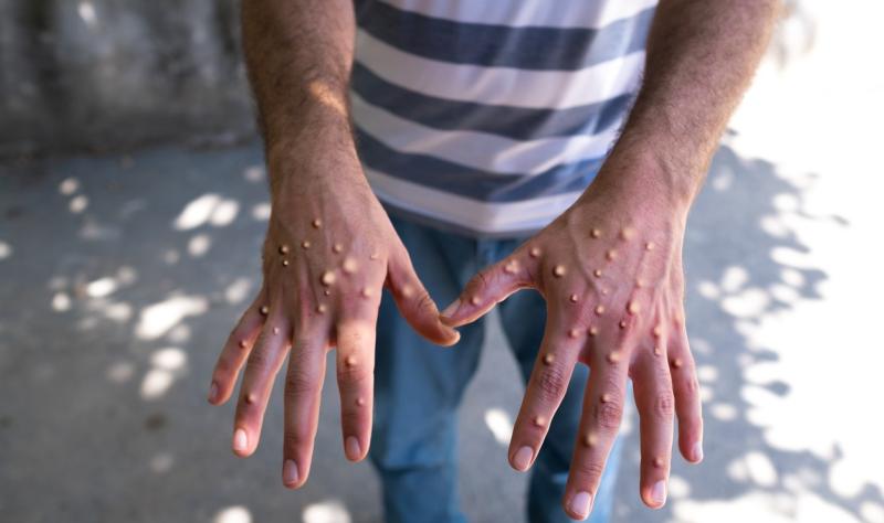 Mpox on back of hands