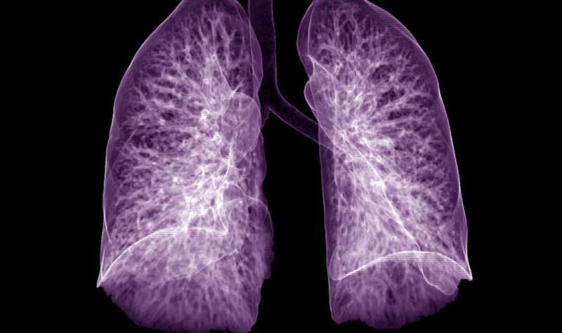 A quarter of COVID-19 survivors had impaired lung function 1 year after infection, and older patients, those with more than three chronic conditions, 