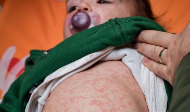 baby with measles
