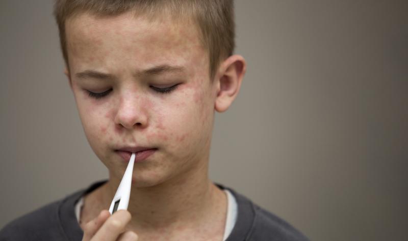 boy with measles