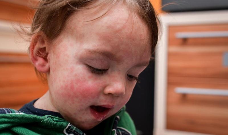 US measles cases approach 500 in worst year since 2019