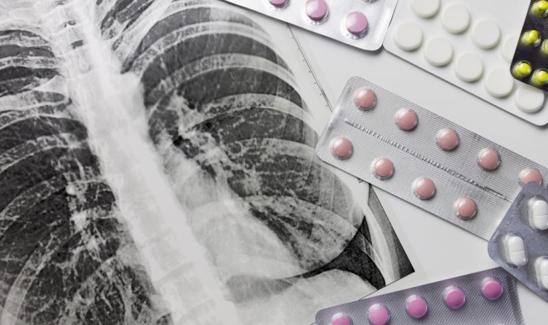 TB x-ray and pills