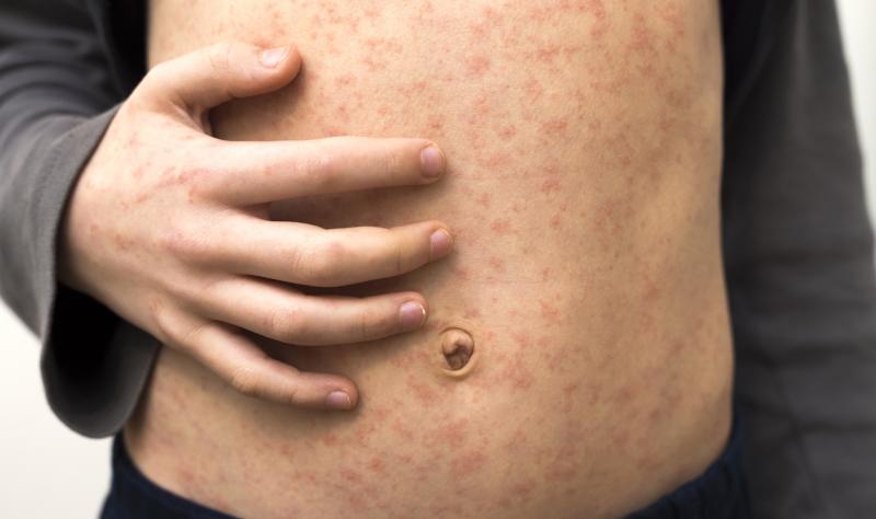 LA County reports first measles case of 2025—in LAX traveler—as cases confirmed in Philadelphia, NY state