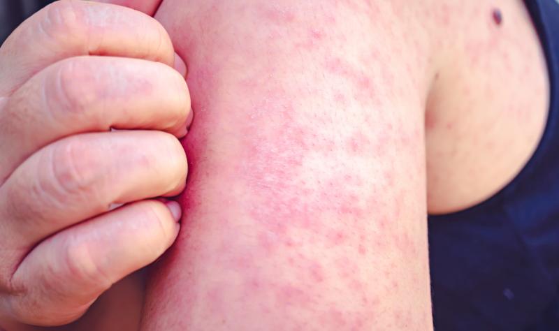 measles itch 