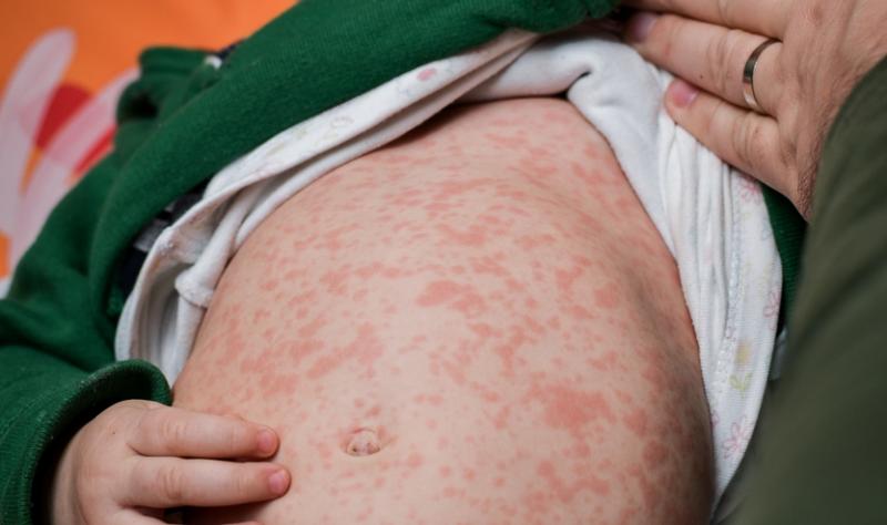 measles boy 