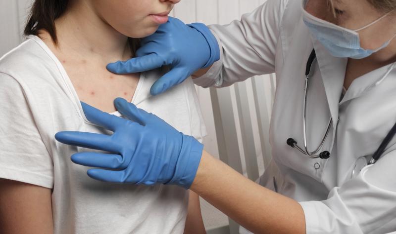 measles check 