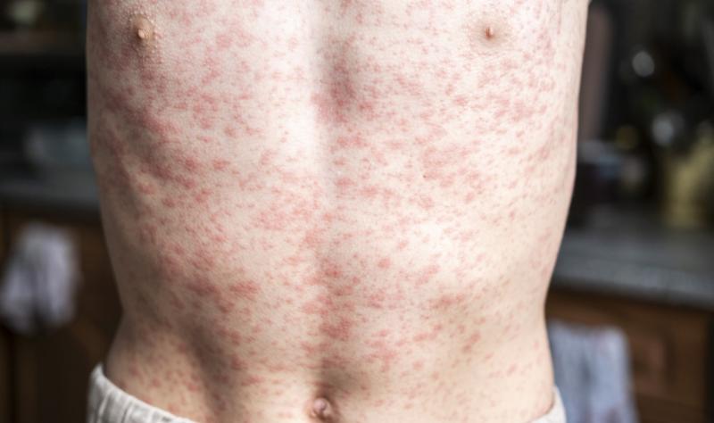 Measles outbreak in South Carolina grows; Canada’s elimination status threatened