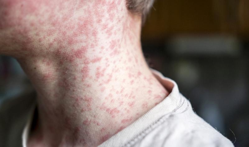 measles on boy's neck and face