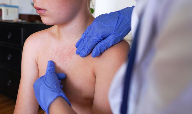 Outbreaks in Southwest, South Carolina grow as US tracks 40 more measles cases