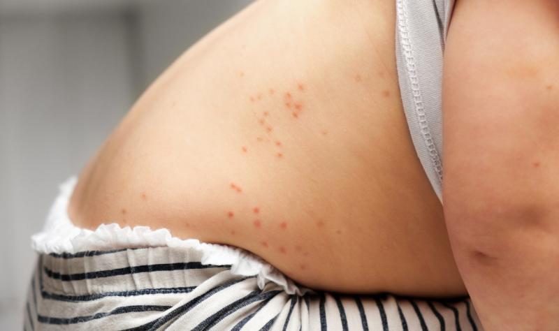 measles child back