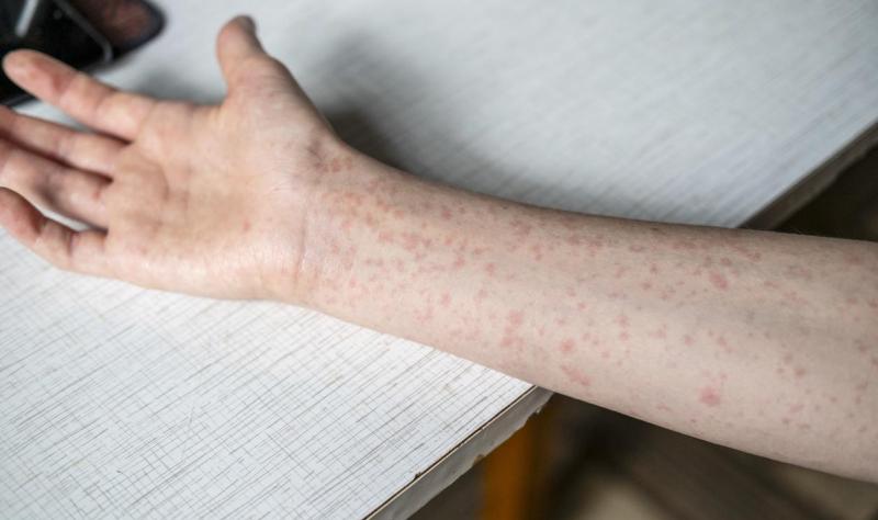 measles rash on arm