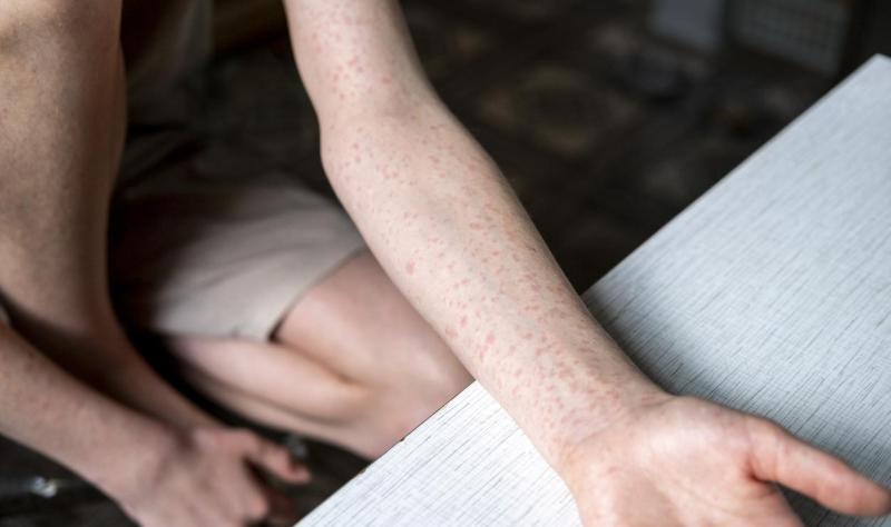 measles teen