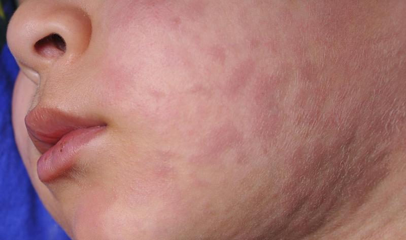 Utah, South Carolina confirm more measles as CDC call suggests US elimination status in jeopardy