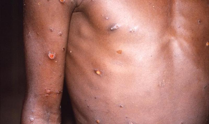 mpox lesions
