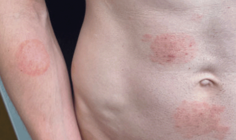 Minnesota health officials warn of sexually transmitted fungal infection outbreak