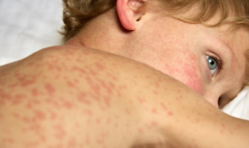 young boy with measles