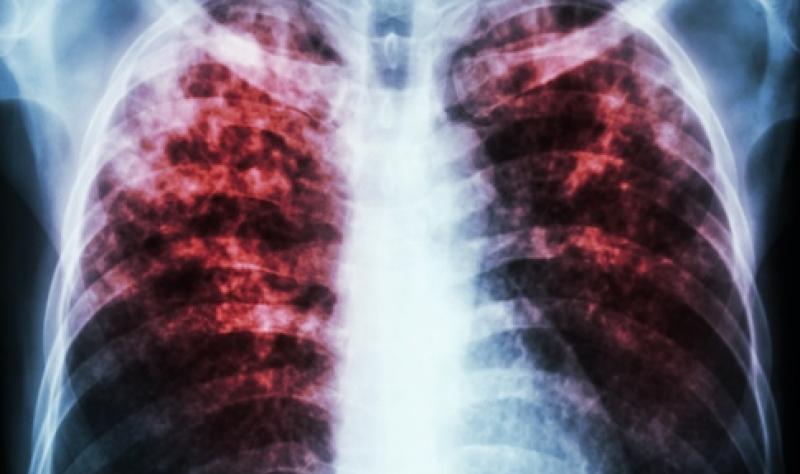 健康・医学 Tuberculosis The Spectrum of Tuberculosis and Why It Matters | Research