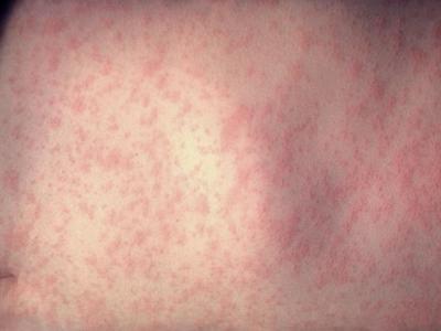measles rash