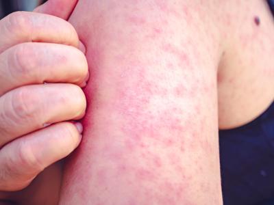 measles arm